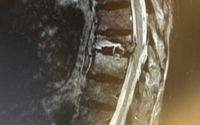 Thoracic Spine Compression Fracture