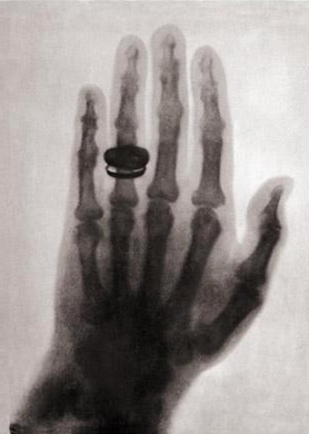 Marie Curie Hand X-ray