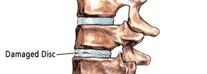 degenerative-disc.png